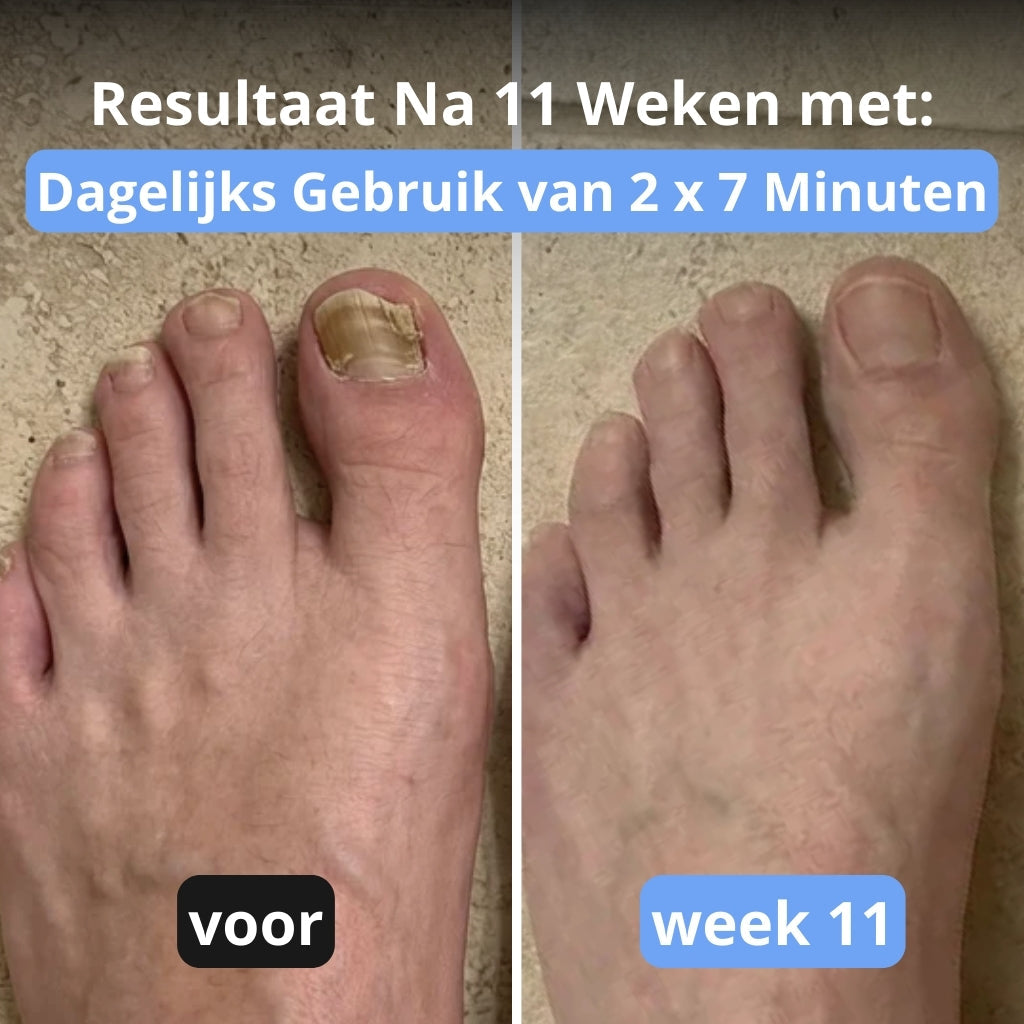 NoraClear™ - 3-in-1 therapie apparaat